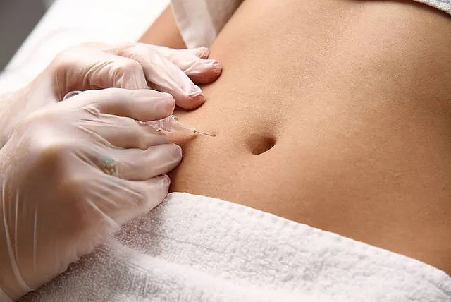 carboxiterapia
